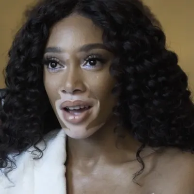 Winnie Harlow